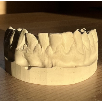 Broken Tooth Filler Grillz